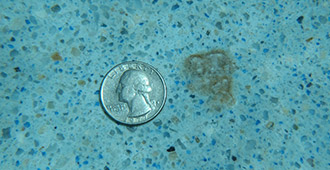 Calcium Nodule Removal